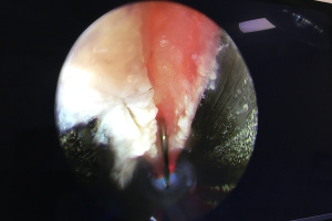 Endoskopická operace karpálního tunelu 